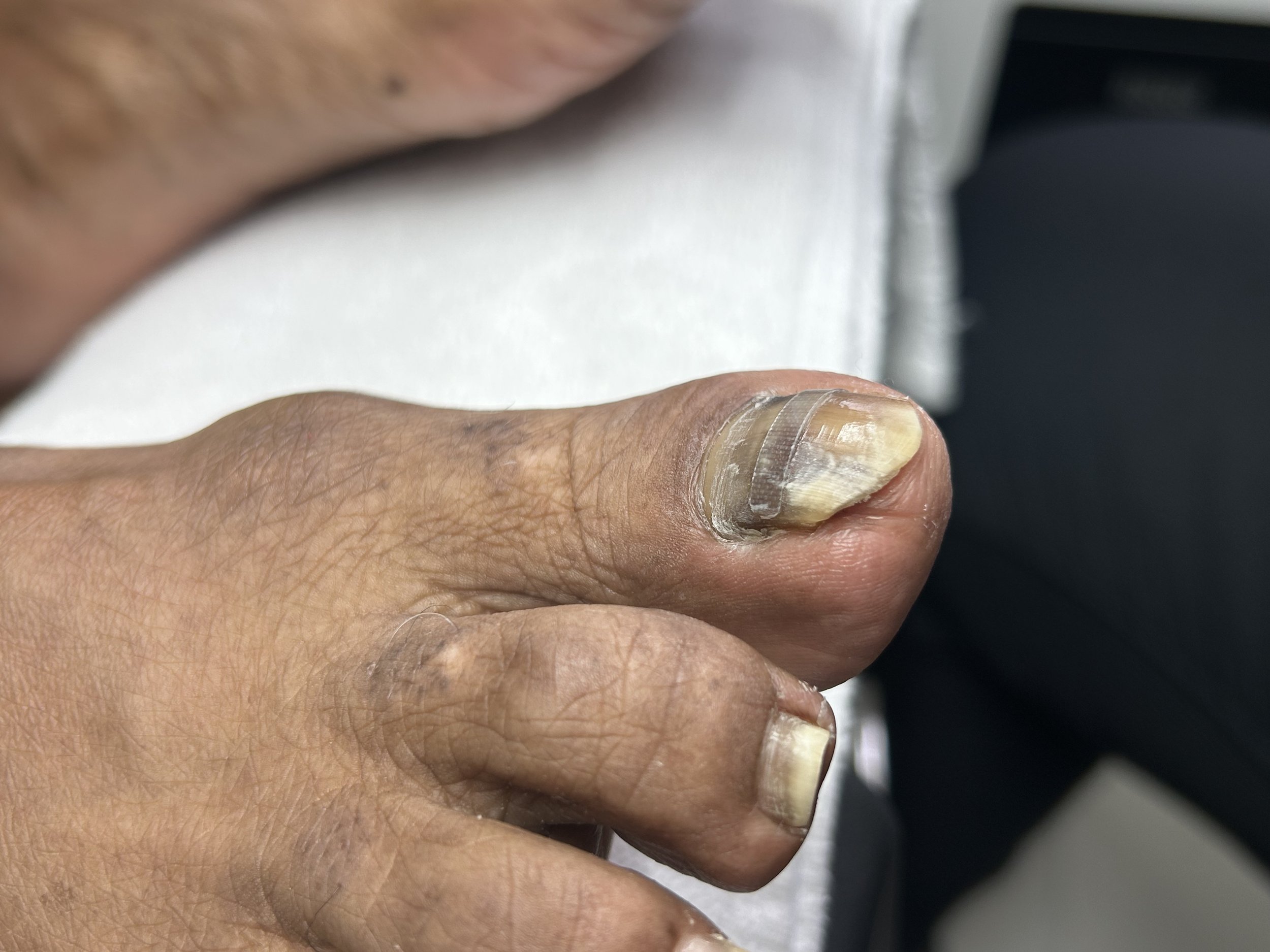 Close-up of a person's hand and thumb with damaged, discolored fingernail, and a plastic nail cap partially covering the nail.