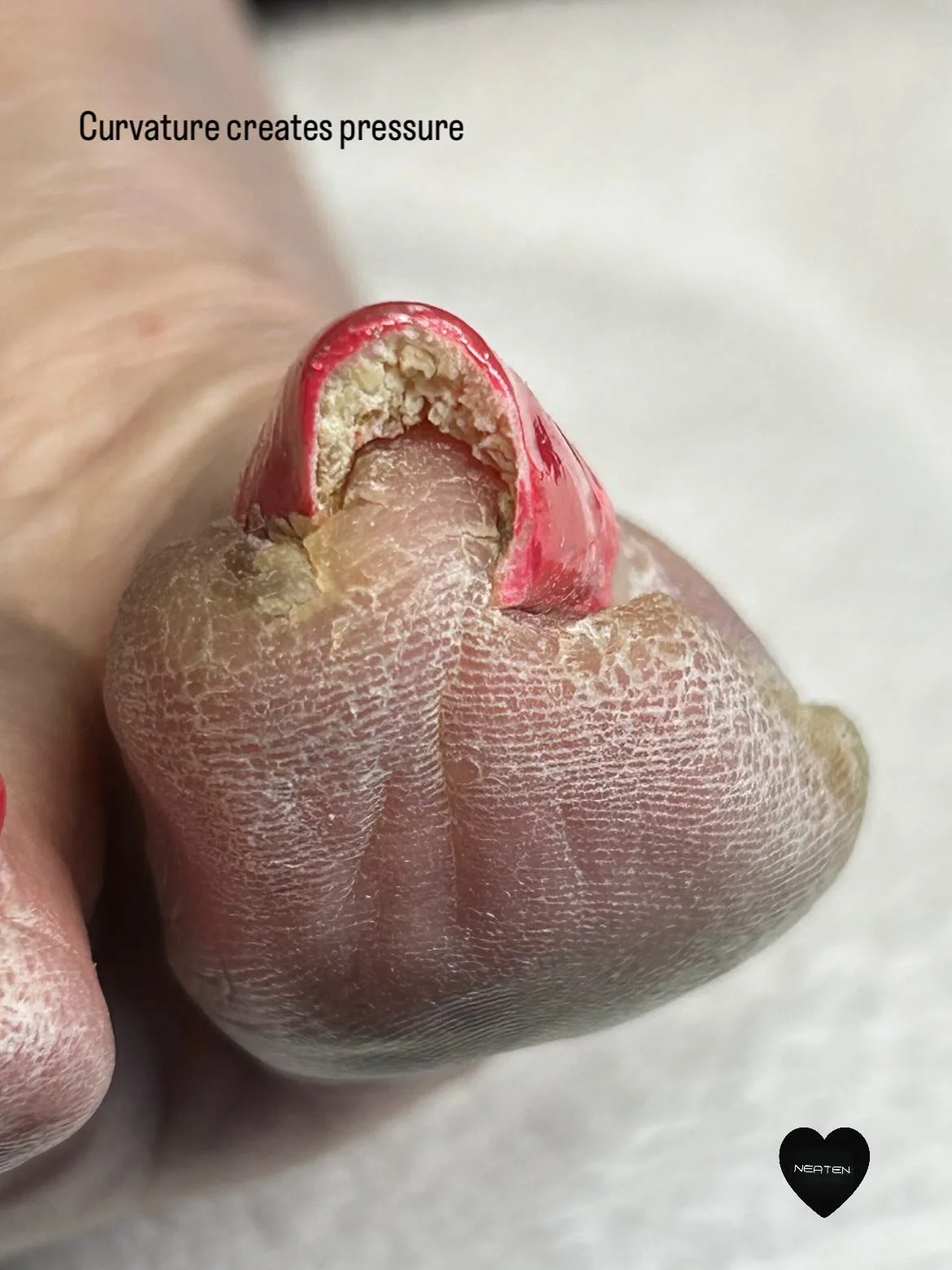 Not all nail curvature stays the same over time.

When pressure from the nail continues repeatedly against the surrounding skin, the tissue can gradually begin adapting to that pressure.

In some cases, the surrounding tissue becomes raised, rounded,