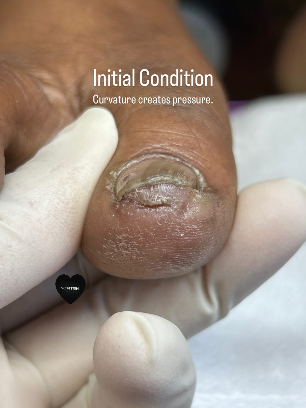 Know Before You Go

What many people describe as &ldquo;extra skin&rdquo; beneath the toenail is often the hyponychium, the protective tissue that seals the area under the nail.

When a toenail becomes excessively curved, pressure can cause this tiss
