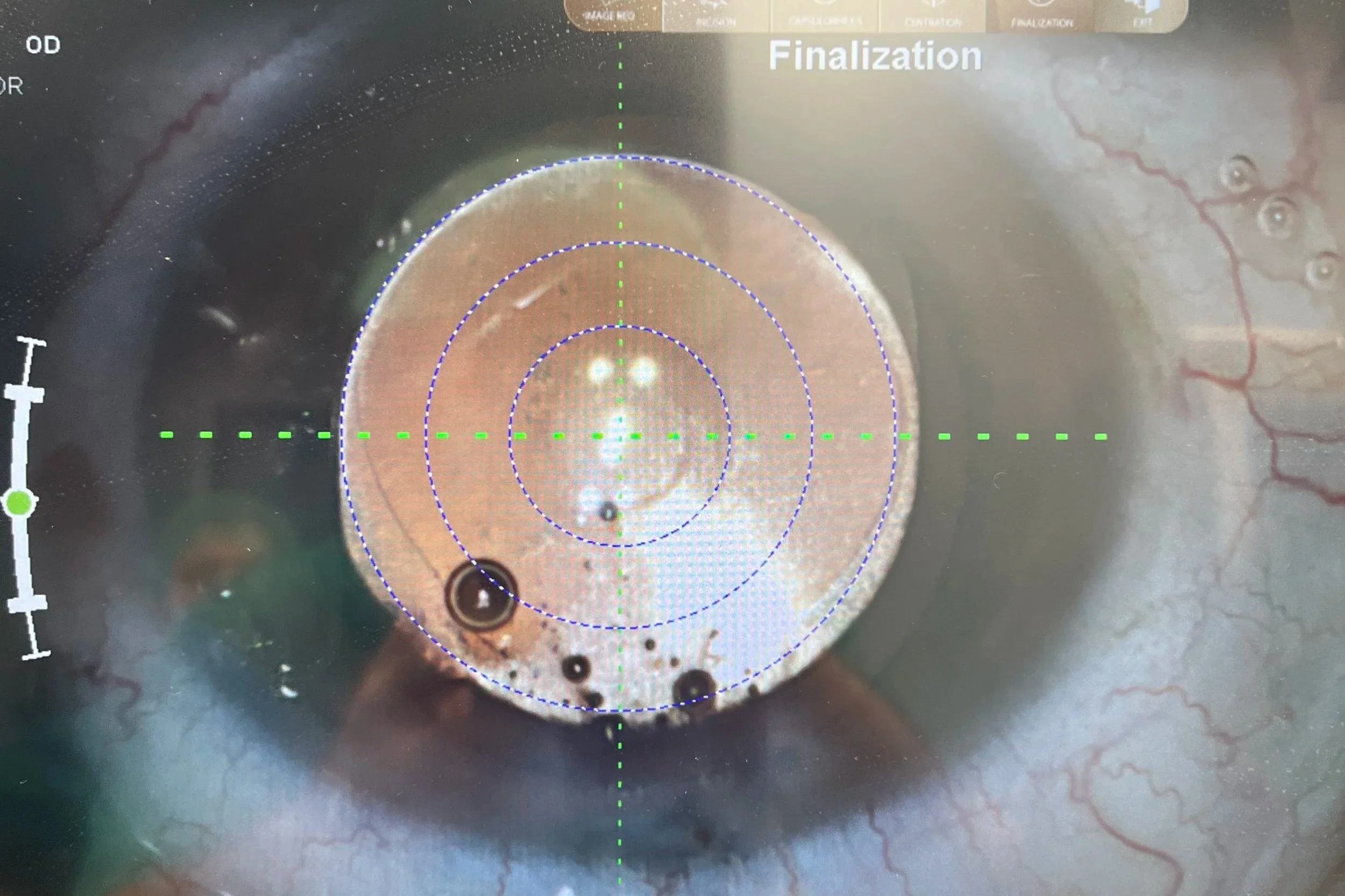 A close-up of a human eye being examined by a medical device, with markings and crosshairs on the screen labeled 'Finalization.'