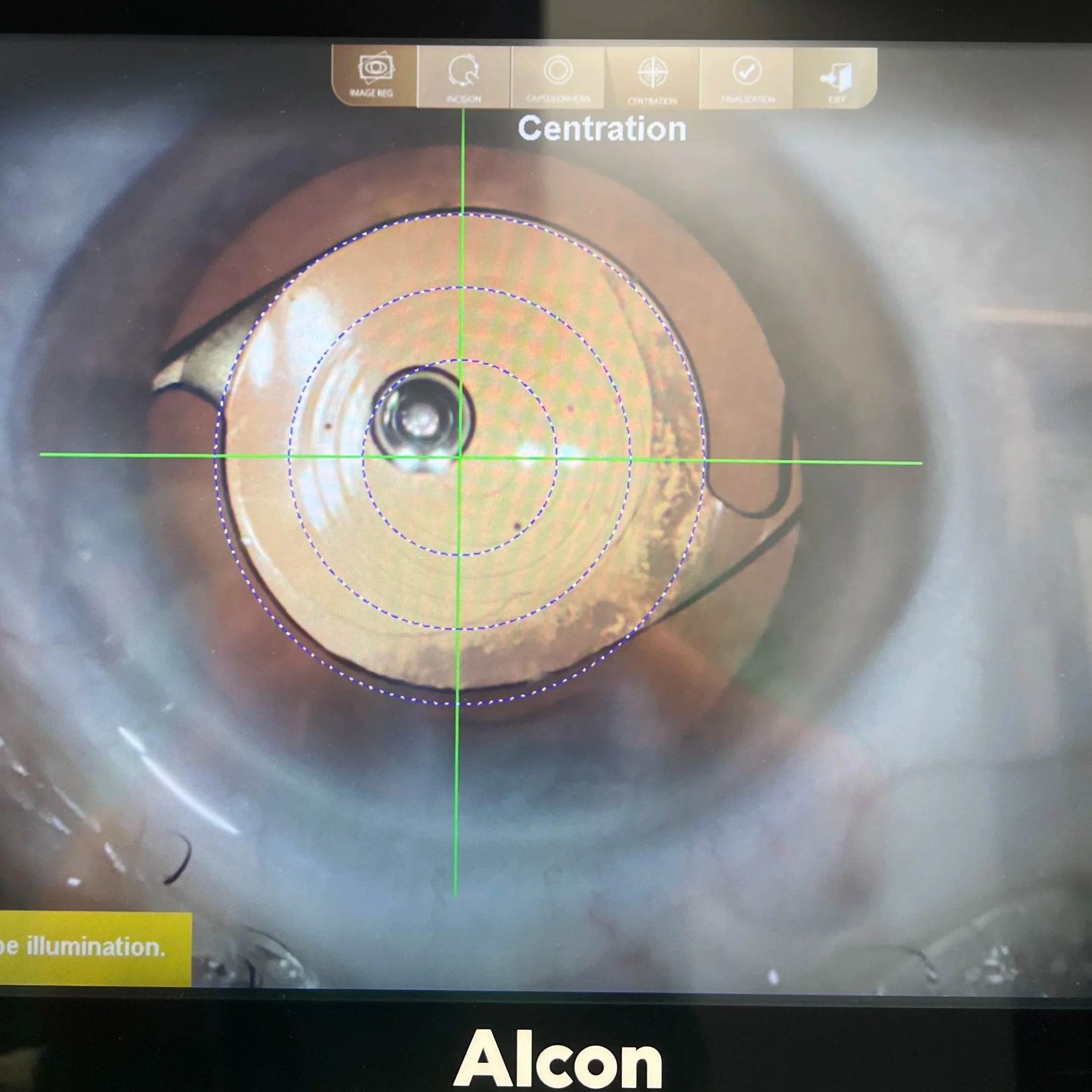 Close-up view of an eye during a medical or laser procedure, with targeting marks and a green crosshair centered on the cornea, and the brand name 'Alcon' at the bottom of the screen.