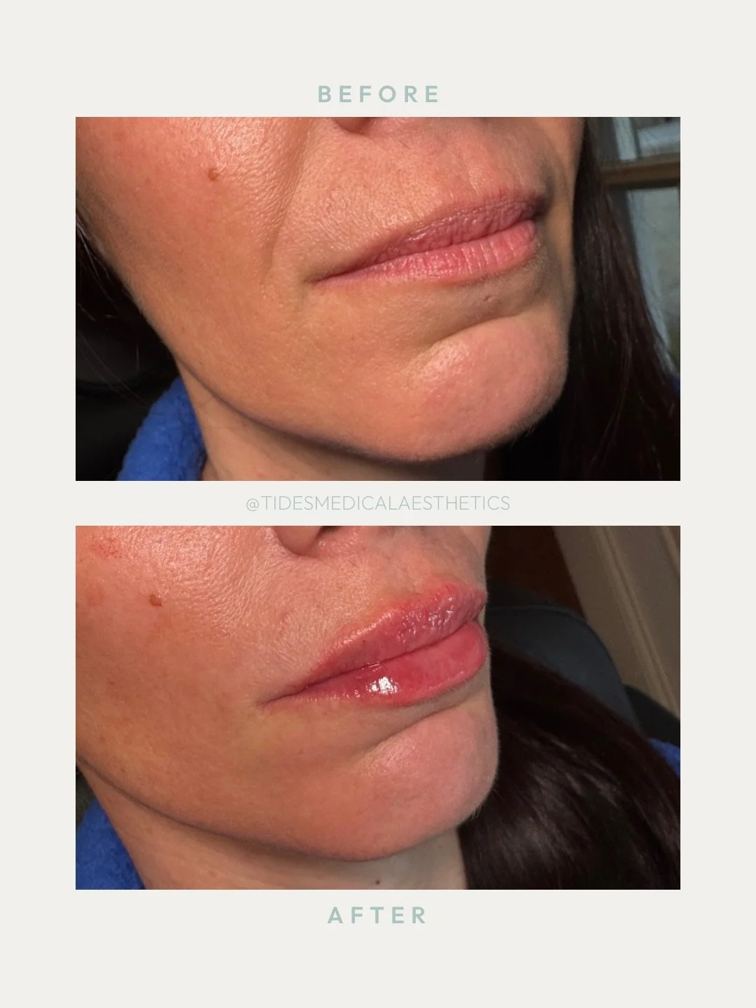 A moment for these lips 😍&nbsp;Subtle plump, natural hydration&hellip; exactly what she asked for 💉

〰️ Treatment: lip filler using Revanesse Kiss

〰️ Time: 45 minutes

〰️ Pain: mild with topical numbing

〰️ Longevity: ~up to 24 months

〰️ Downtime