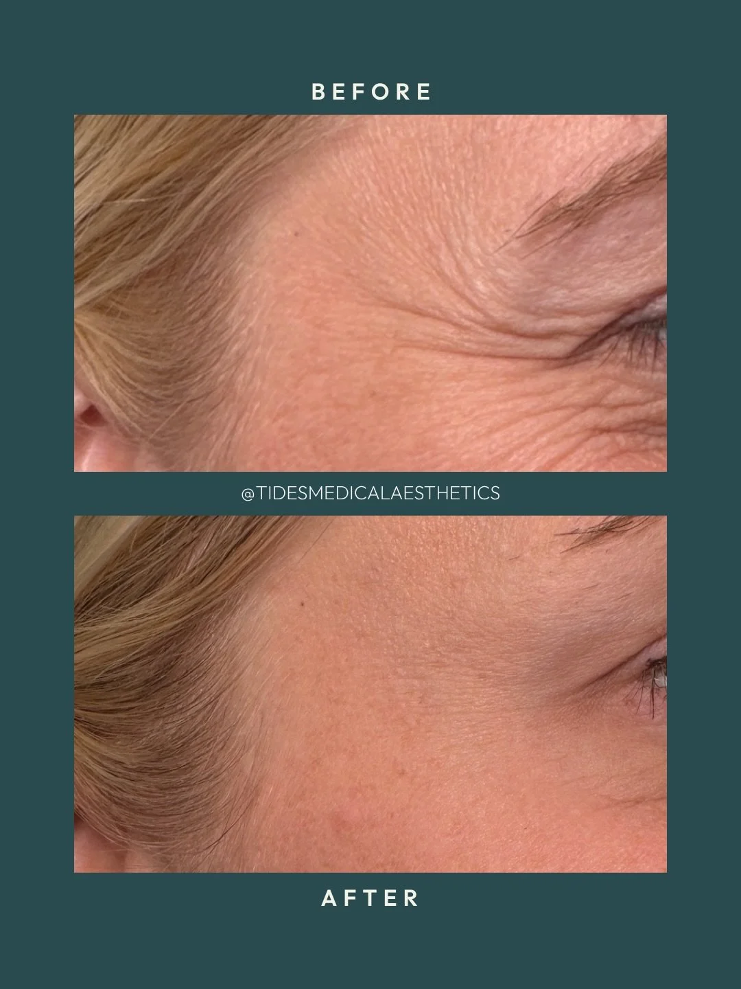 Crow&rsquo;s feet are one of my favourite areas to treat and the difference here speaks for itself. She loved how smooth her skin looked at her two week follow up 🤍

When it comes to dynamic and static lines on the face, neuromodulators work by rela