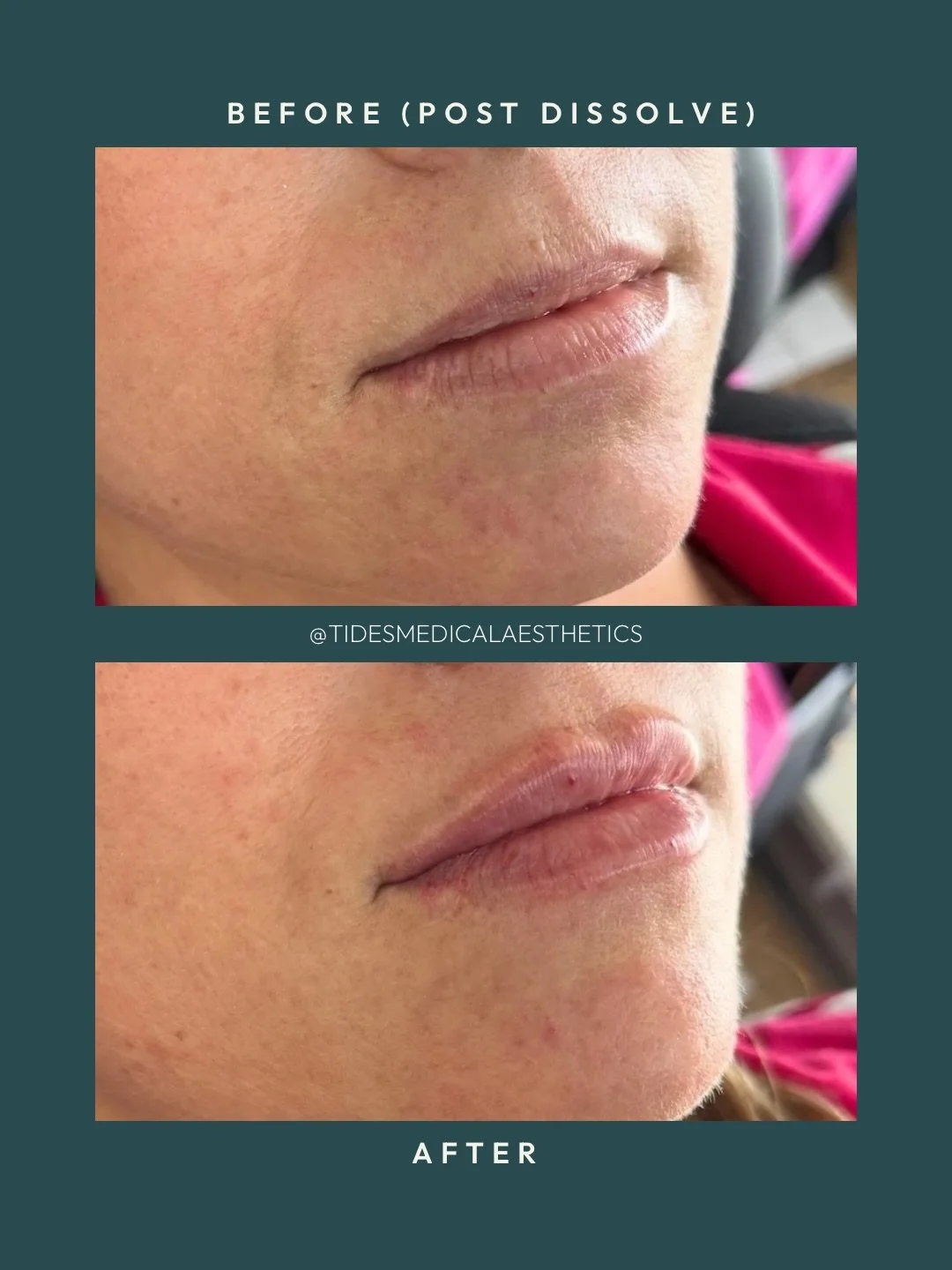 Sometimes the best thing to do is start fresh 💋 This patient came in with existing lip filler that wasn&rsquo;t sitting the way she wanted anymore. Instead of adding more, we decided together to dissolve and give her lips a full reset.

2x dissolvin