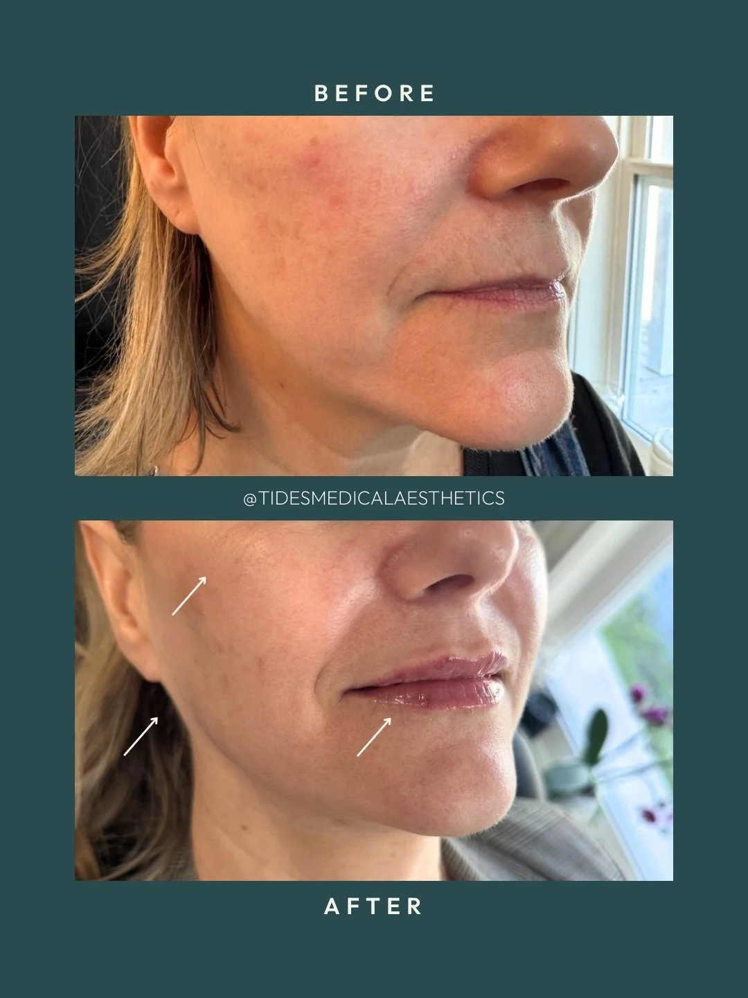 What a little support and structure can do 😍&nbsp;For this patient we worked across several areas over two separate appointments - cheek filler to restore midface support, then lip filler and gonial angle (the angle of the jaw) to bring balance and 