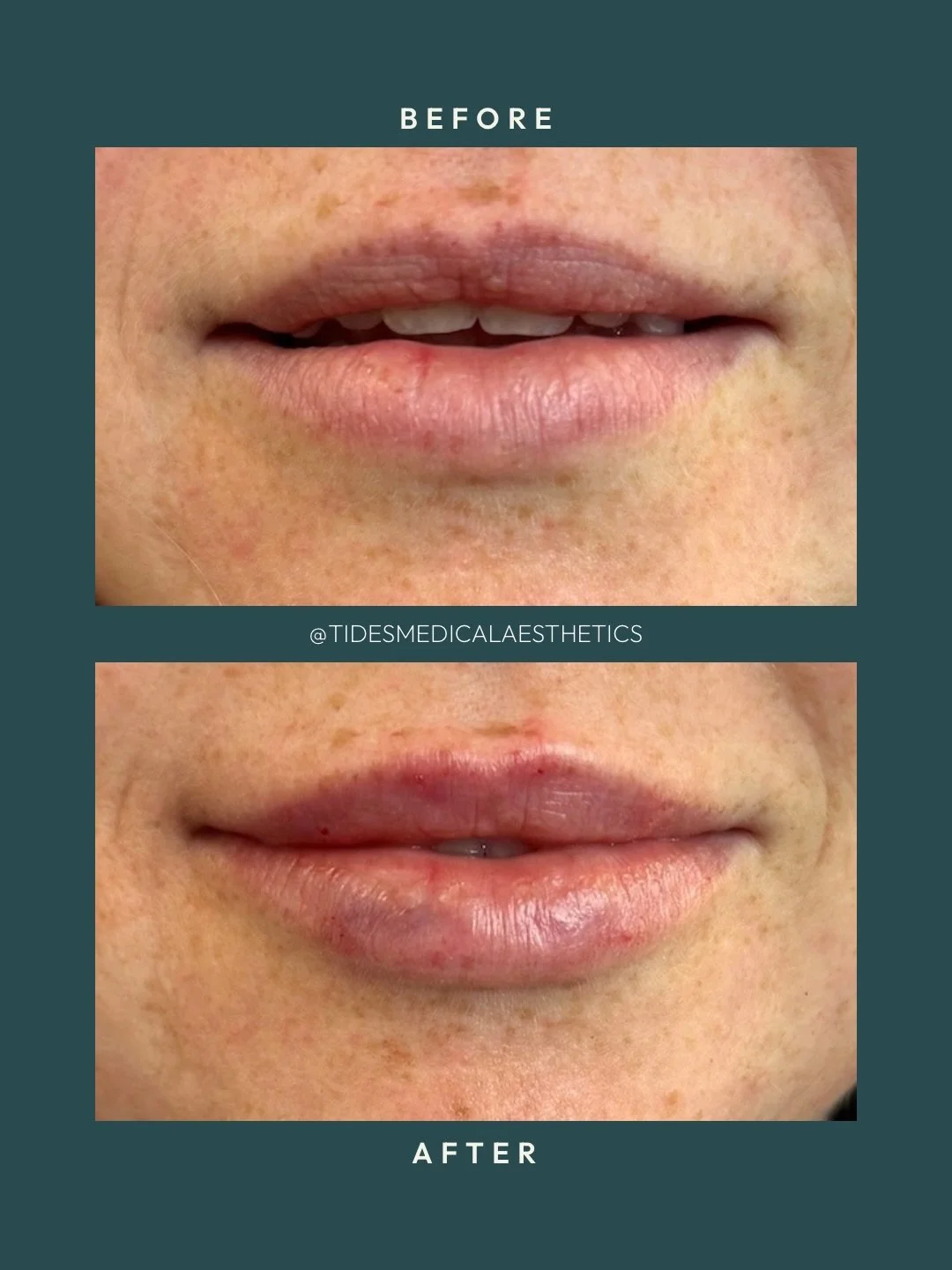 She requested a fuller lip that&rsquo;s more defined but not overdone. I think we checked all the boxes 😍

〰️ Treatment: lip filler

〰️ Time: 45 minutes

〰️ Pain: mild with topical numbing

〰️ Longevity: ~up to 24 months

〰️ Downtime: avoid heat and