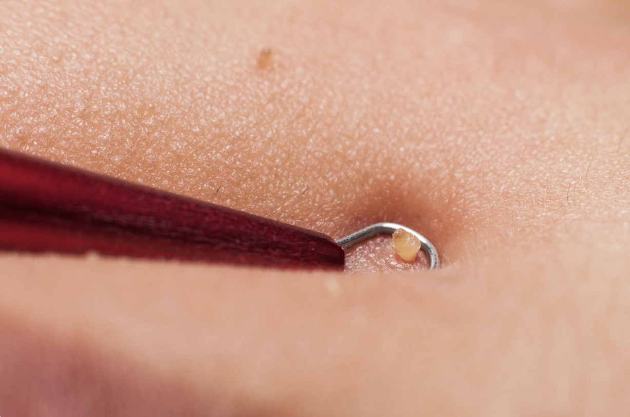 Your Skin Barrier Might Be Making Your Hyperpigmentation Worse