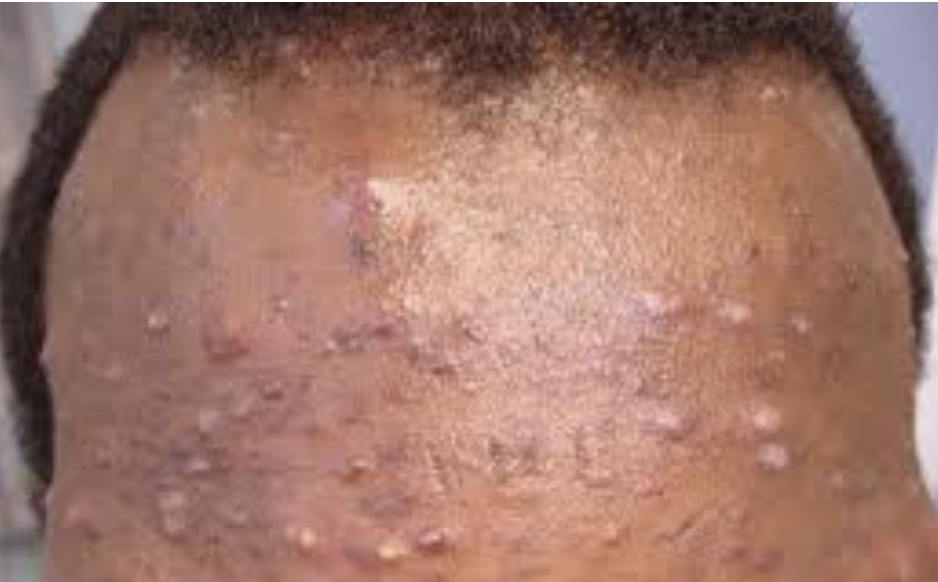 Inflammation Is the Root of Hyperpigmentation—Here’s What to Do