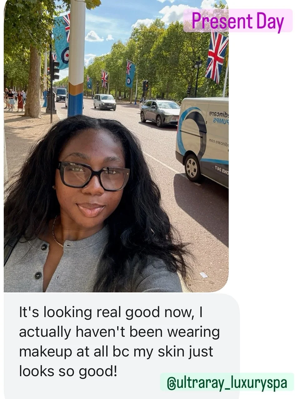 This is the goal of the UltraRay Hyperpigmentation Program!! 🎉✨

As @_justefarah is nearing the end of the program, we are continuing to see major improvements in her skin; the acne breakouts are under control and the hyperpigmentation is continuing