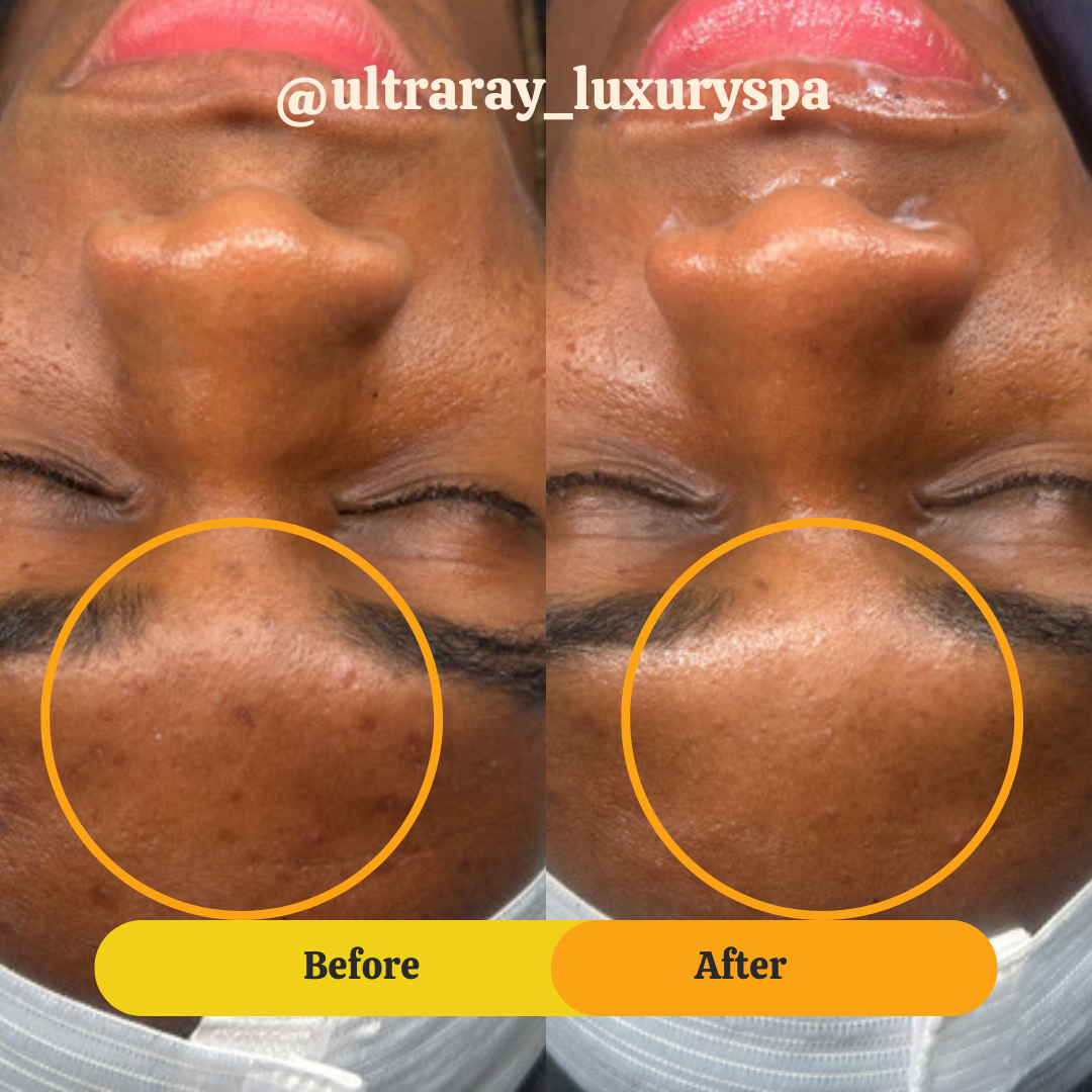 Side-by-side comparison of a person's face showing skin improvement on the chin area, with before and after images. The mood is showcasing skincare results, with the 'before' image on the left and 'after' on the right. The person's eyes are closed, a