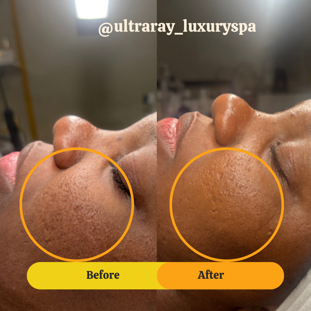 Side-by-side comparison photo showing a person's cheek before and after a skincare treatment. The 'Before' side shows rough, uneven skin with visible texture and pores, while the 'After' side shows smoother, clearer skin with reduced pore visibility.