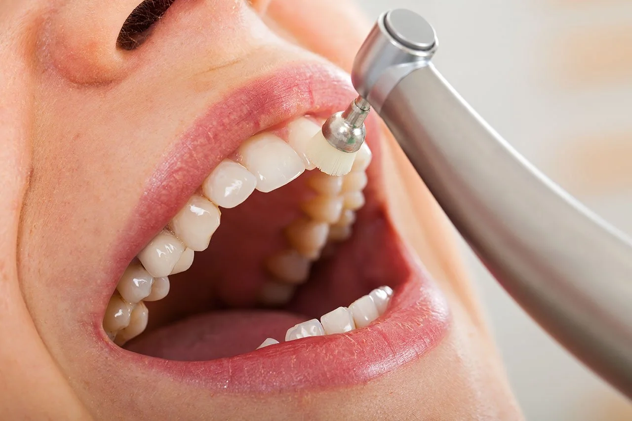 Professional Teeth Cleaning: The “Reset Button” Your Brush Can’t Fully Replace