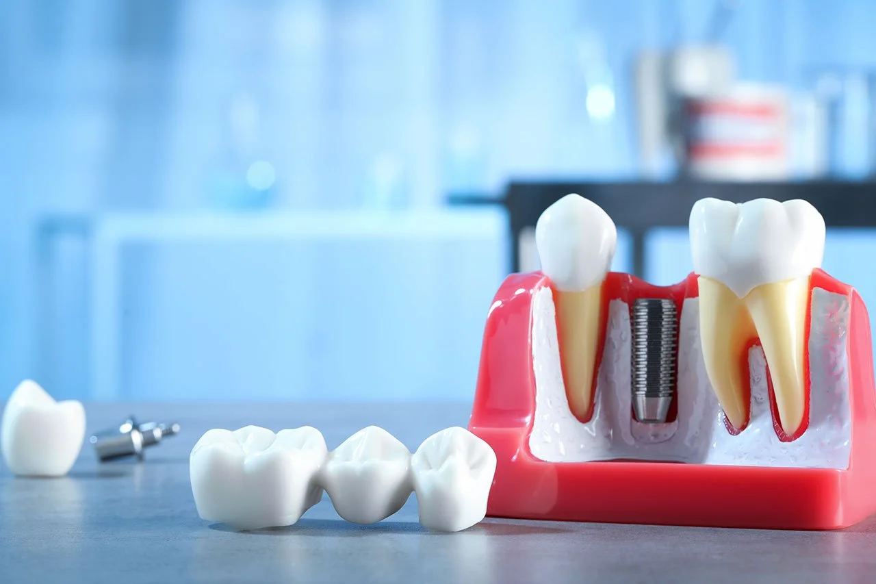 Why Replacing Missing Teeth Early Can Protect Your Long-Term Oral Health