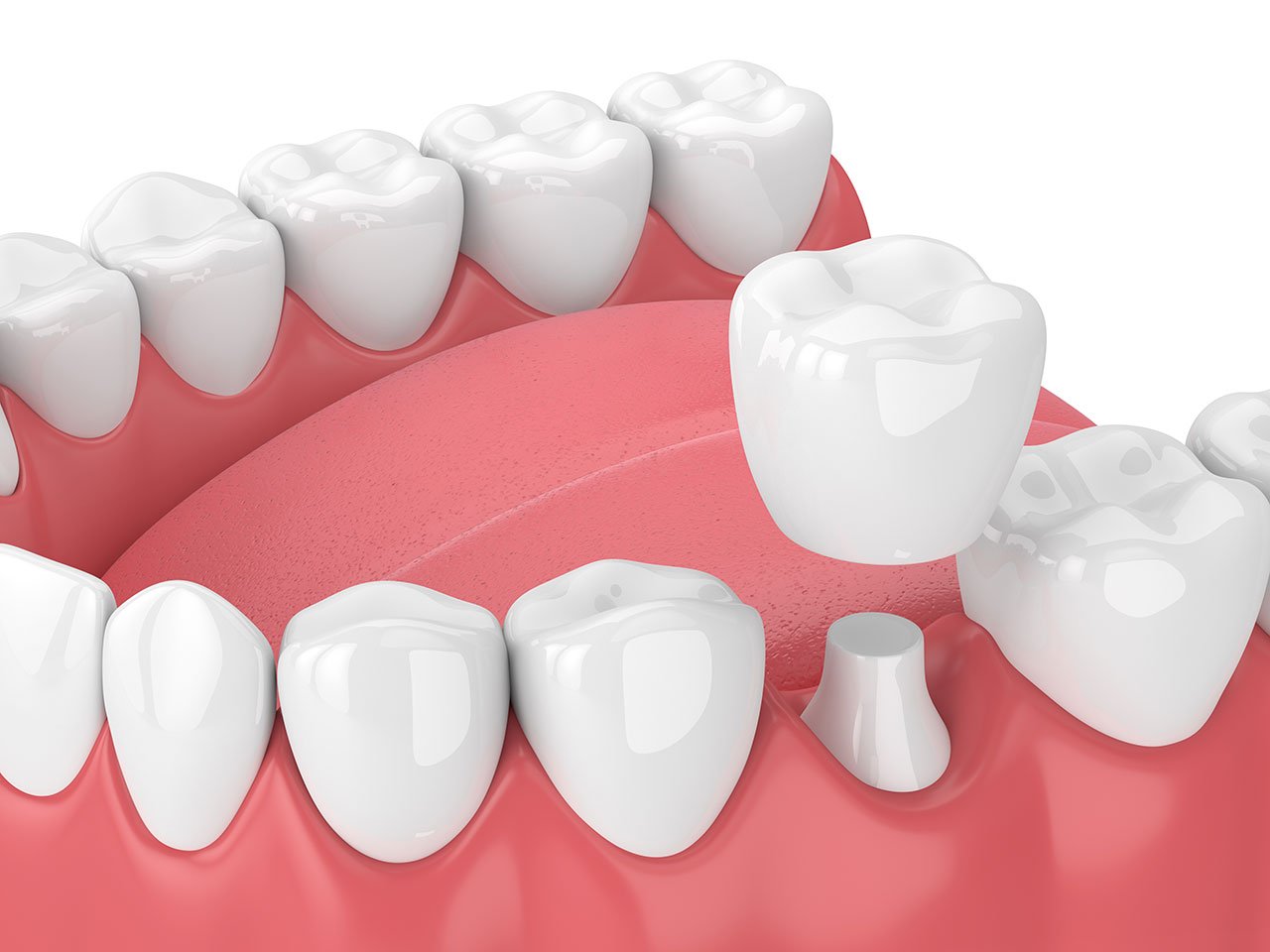 How Same-Day Dental Crowns Help Patients Save Time Without Sacrificing Quality