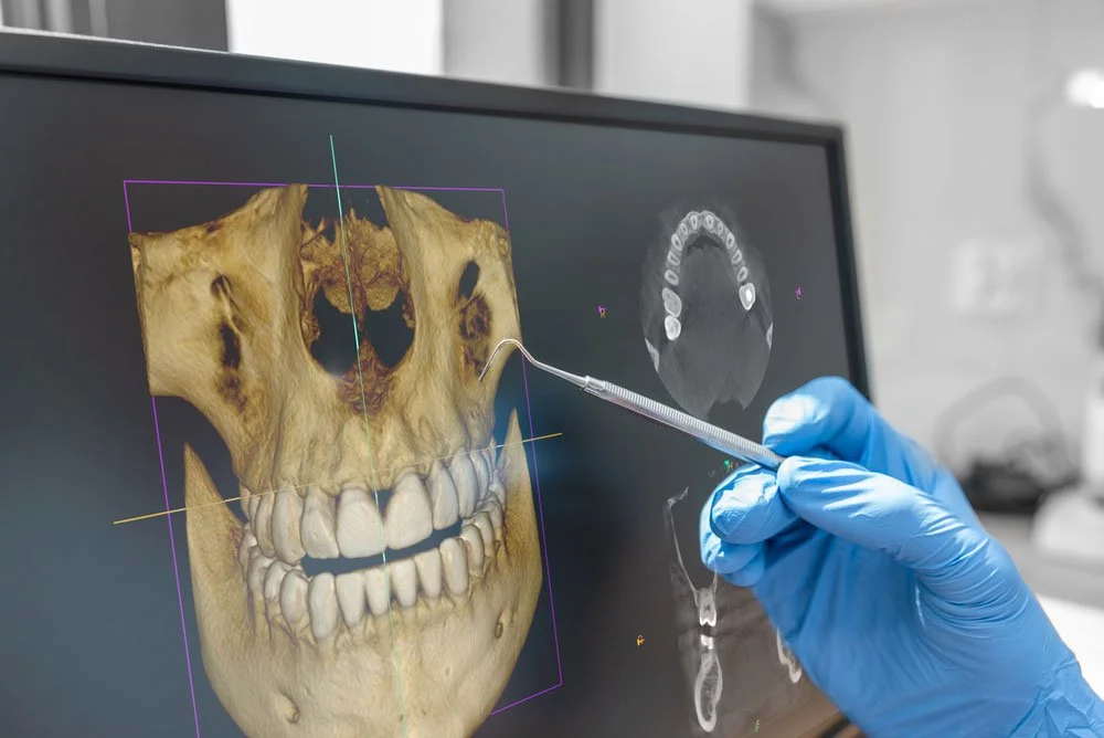 Do You Need a Bone Graft Before a Dental Implant?