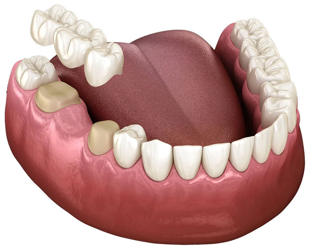 Dental Bridge Rendering in North Seattle