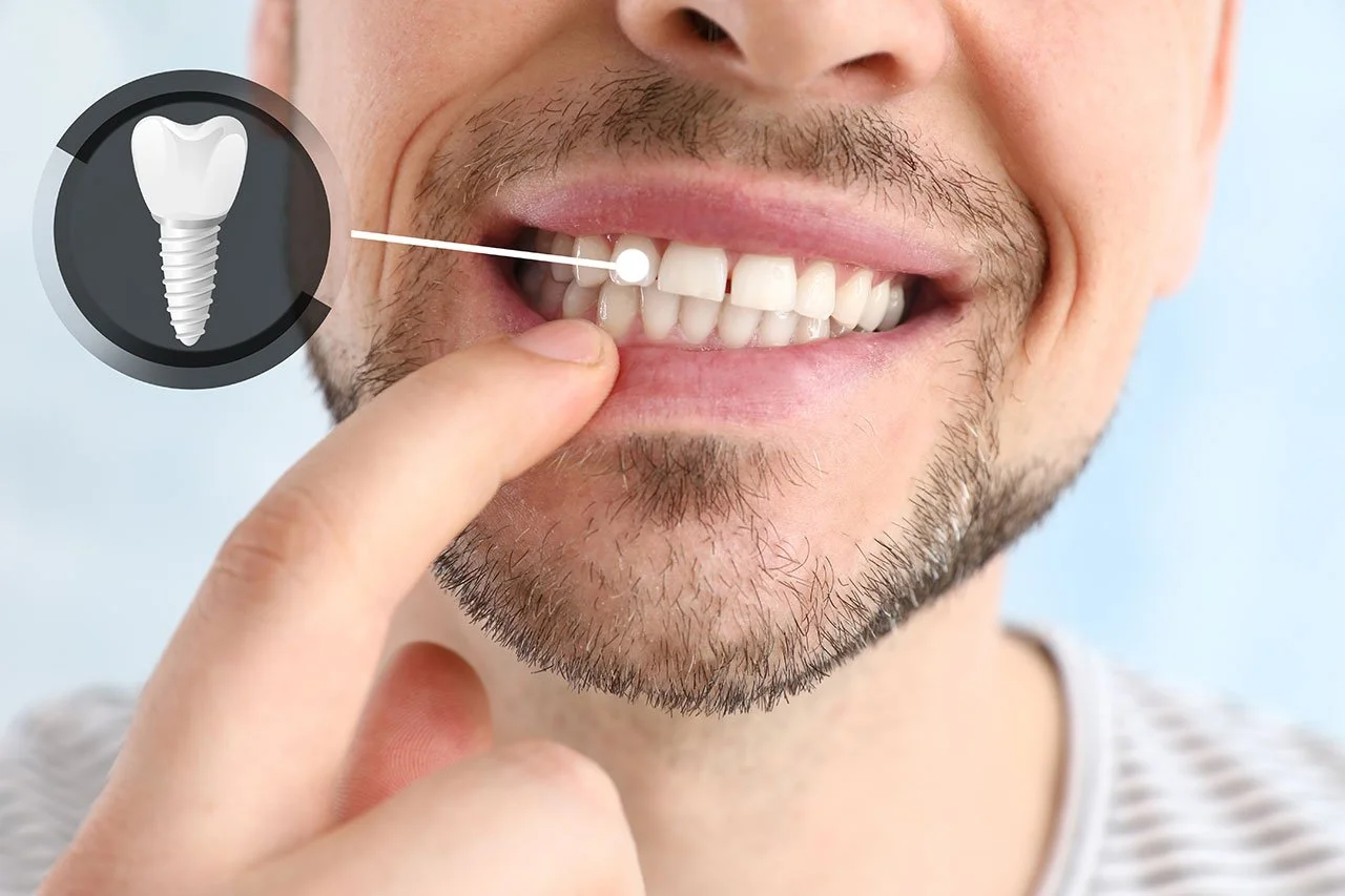 Close-up of a man pointing to his smile as a dental implant graphic highlights a tooth replacement procedure.