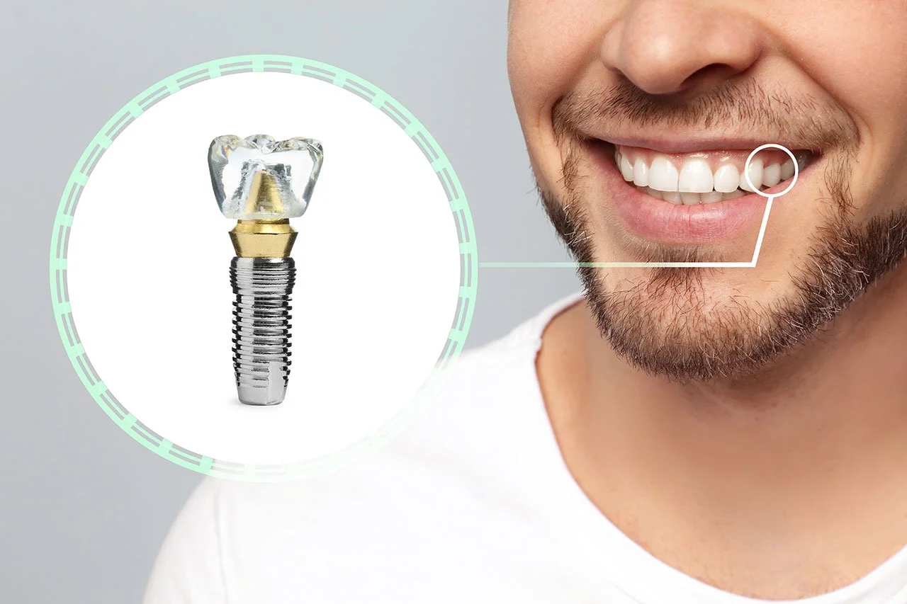 Implant Restoration in North Seattle