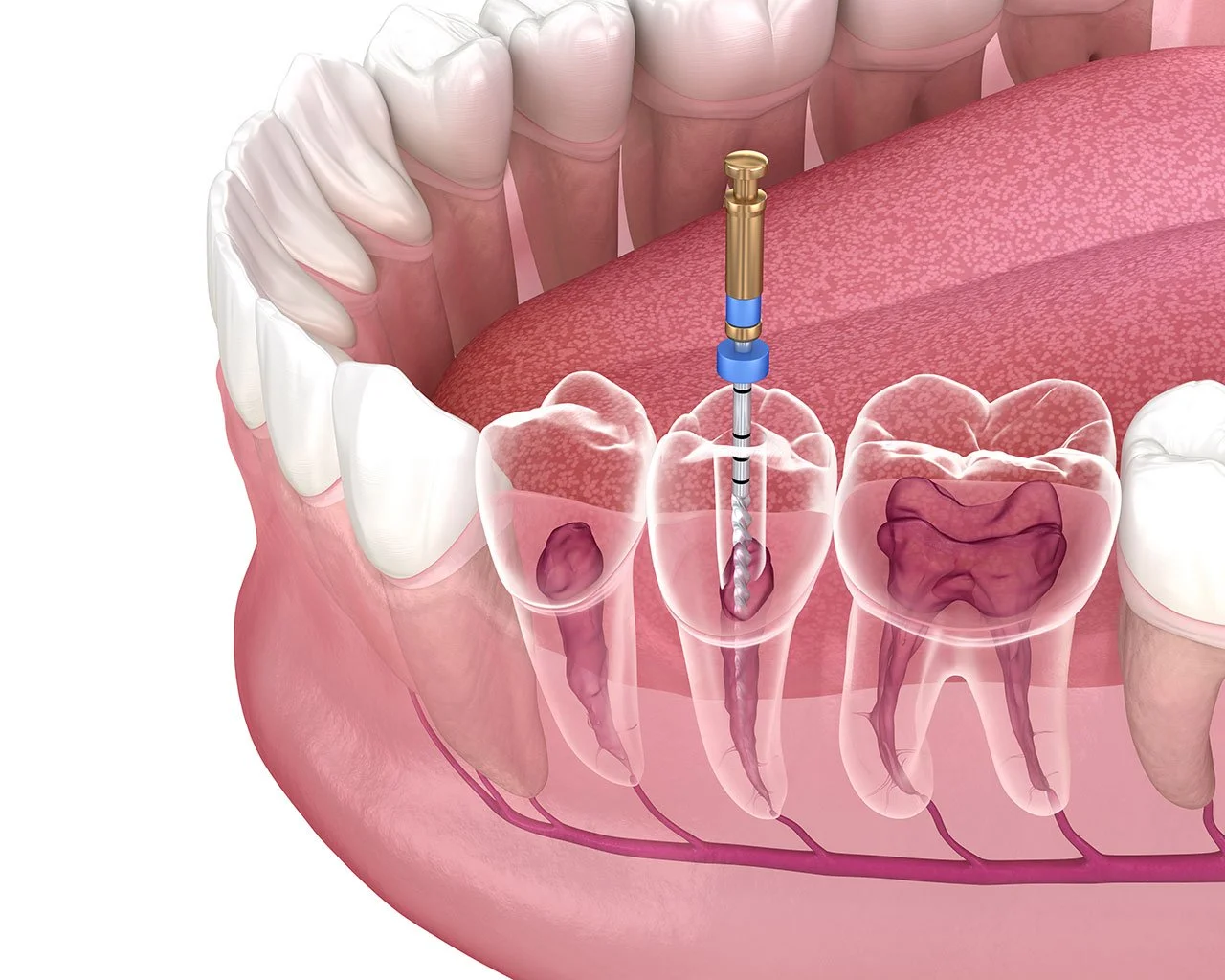 Same Day Root Canal Treatment in North Seattle