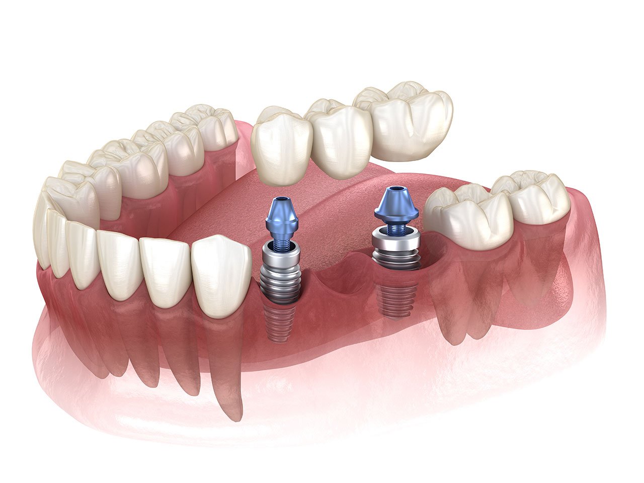 Dental Implant Bridge Rendering