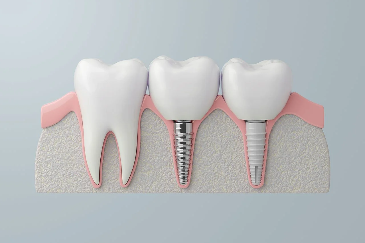 Diagram of dental implants replacing teeth, showing one natural tooth, one with a screw-in implant, and a third with a surface implant in the gum.