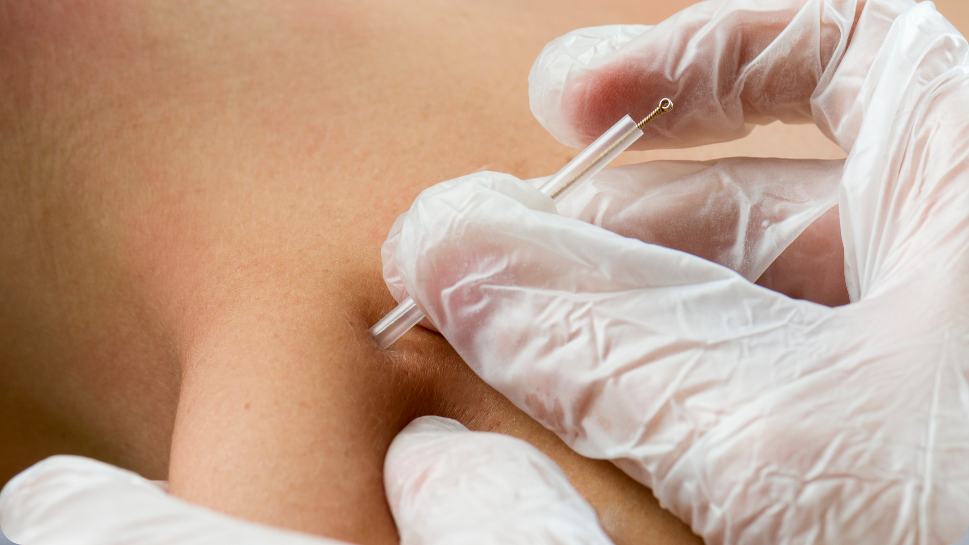Let's Bust Some Dry Needling Myths (And Set the Record Straight)