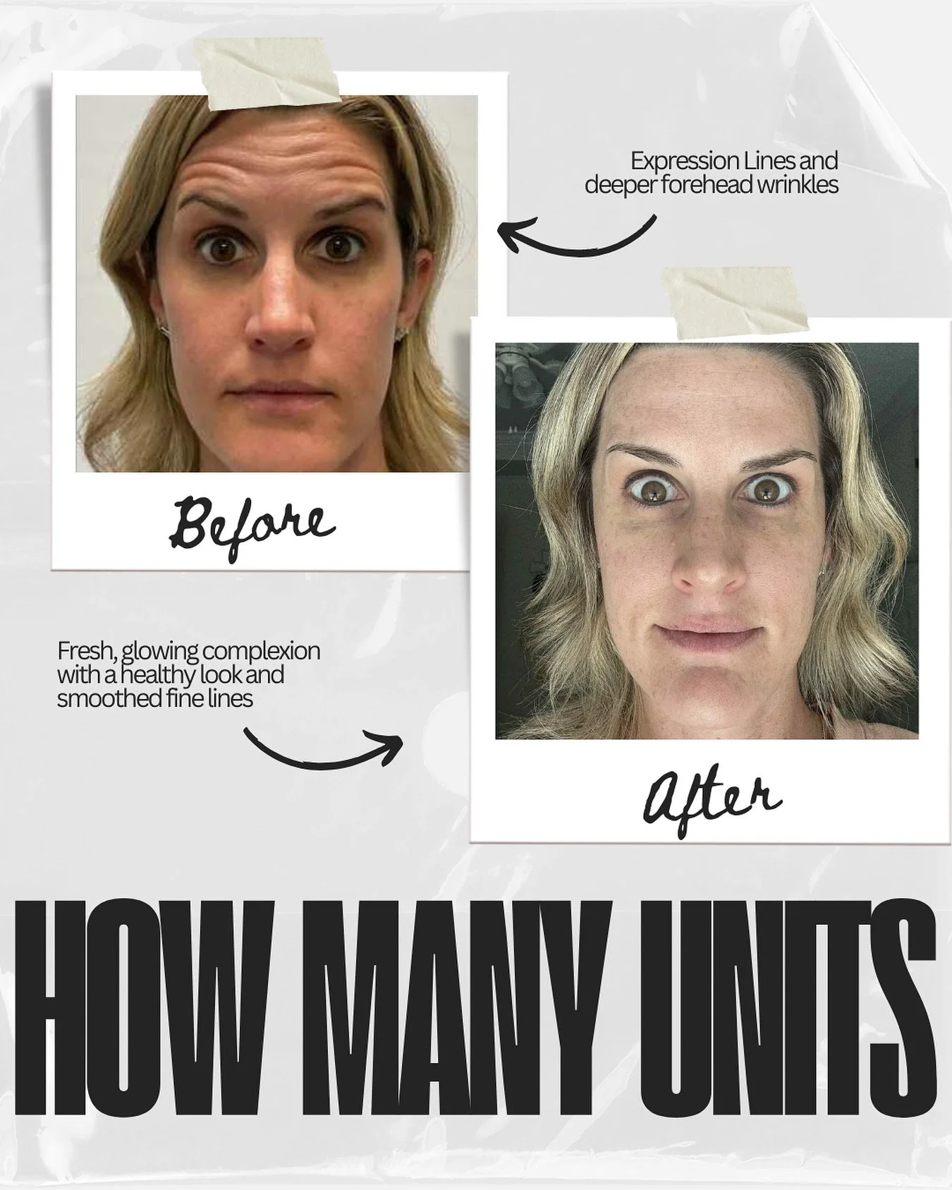 Smooth results, natural look! 
Can you guess how many units of Botox were used to achieve this result? 👀💉 

🧠 Drop your guesses below! 
I&rsquo;ll reveal the answer (and the breakdown) in my stories later today. 👇👇 

#BotoxGuessGame #SmoothNotFr