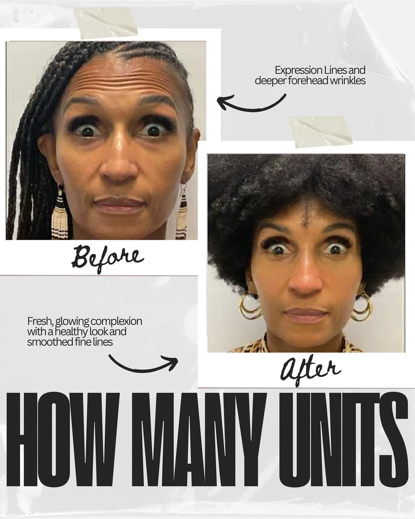 Achieve smooth results with a natural appearance! 

Can you guess the number of Botox units used for this look? Drop your guesses in the comments below! 

I&rsquo;ll share the answer and details in my stories later today. 

#BotoxGuessGame #SmoothNot