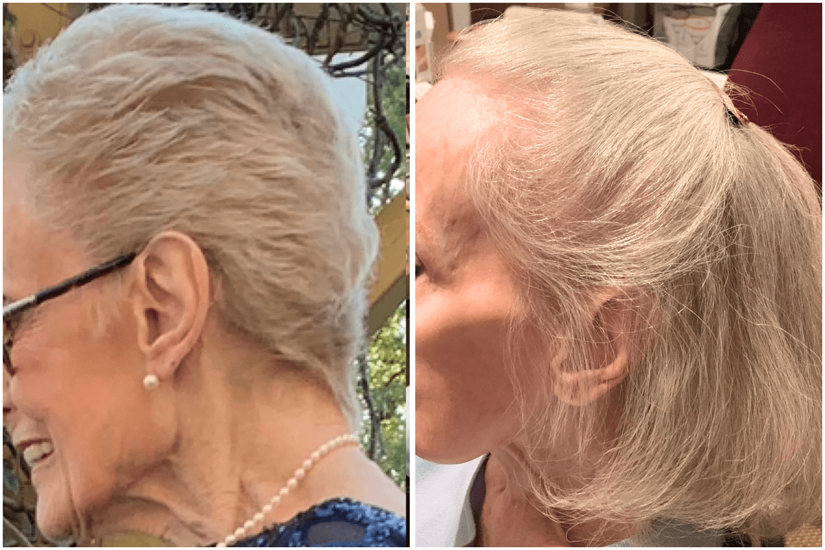 Hair-loss-restoration-Viva-Carmel-by-the-Sea-aesthetic-dermatology-medspa-results-transformation-products-before-after.png