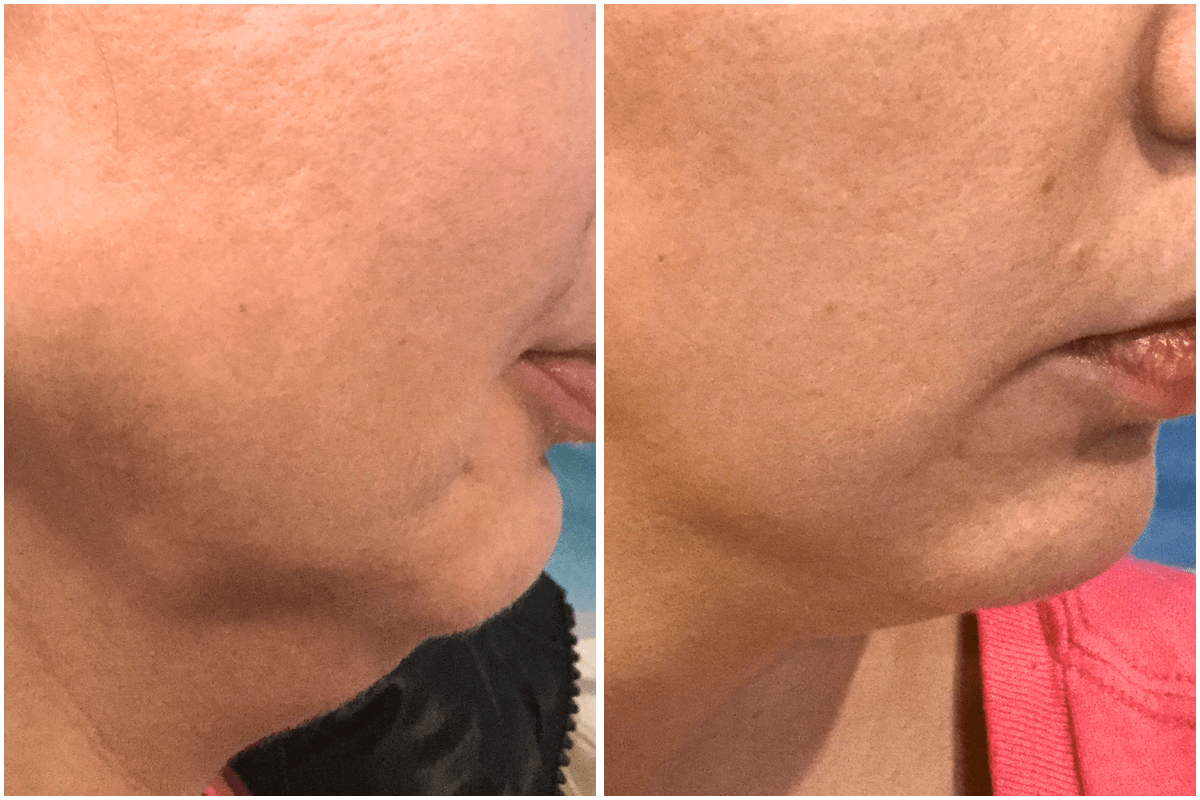 Jawline-rejuvenation-side-Viva-Carmel-by-the-Sea-aesthetic-dermatology-medspa-results-transformation-botox-facial-filler.png
