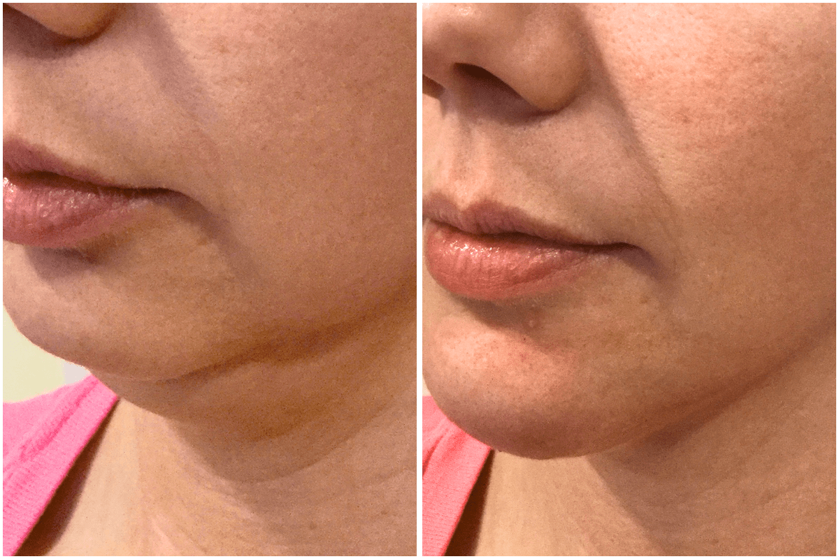 Jawline-rejuvenation-Viva-Carmel-by-the-Sea-aesthetic-dermatology-medspa-results-transformation-botox-facial-filler.png