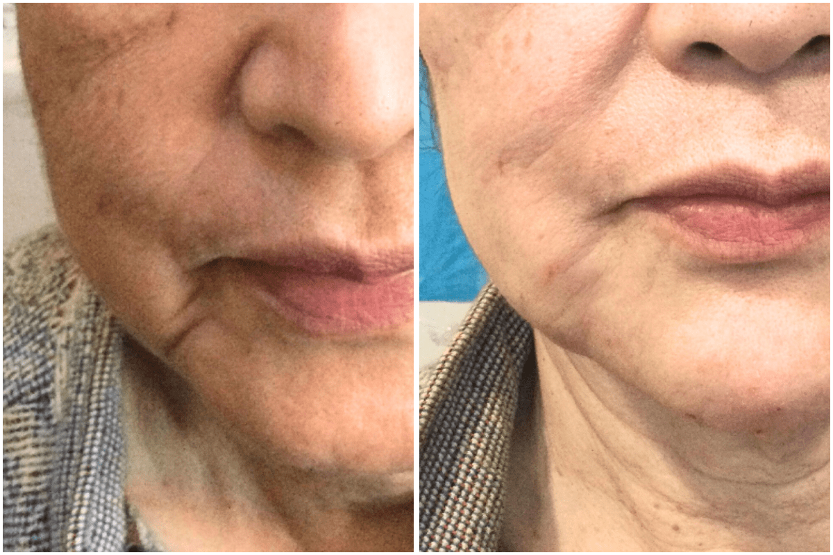 Microneedling-Pigmentation-Viva-Carmel-by-the-Sea-aesthetic-dermatology-medspa-results-transformation-botox-facial-filler.png