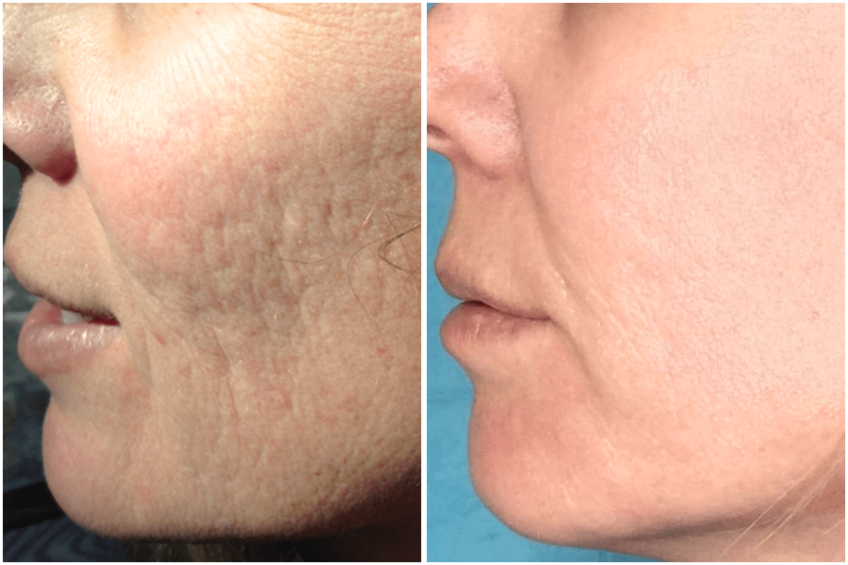 Microneedling-scar-reduction-Viva-Carmel-by-the-Sea-aesthetic-dermatology-medspa-results-transformation-botox-facial-filler.png