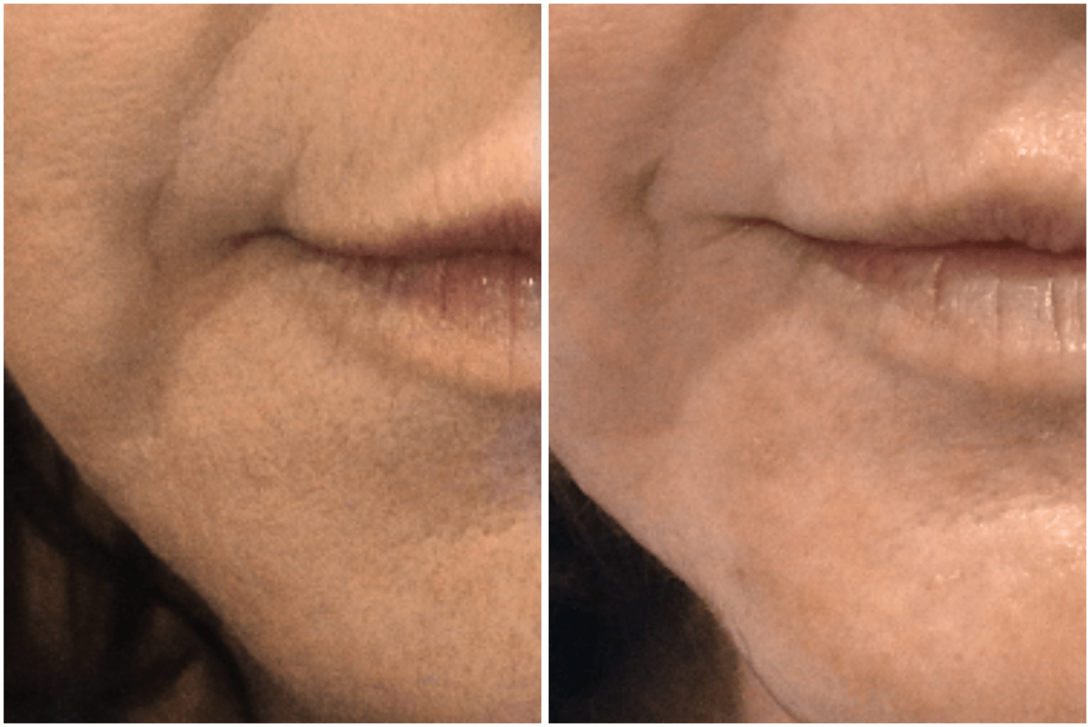 Jowl-reduction-Viva-Carmel-by-the-Sea-aesthetic-dermatology-medspa-results-transformation-botox-facial-filler.png