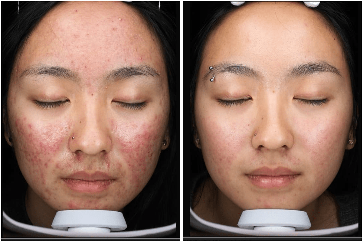 rosacea-acne-treatment-Viva-Carmel-by-the-Sea-aesthetic-dermatology-medspa-results-transformation-products-before-after.png
