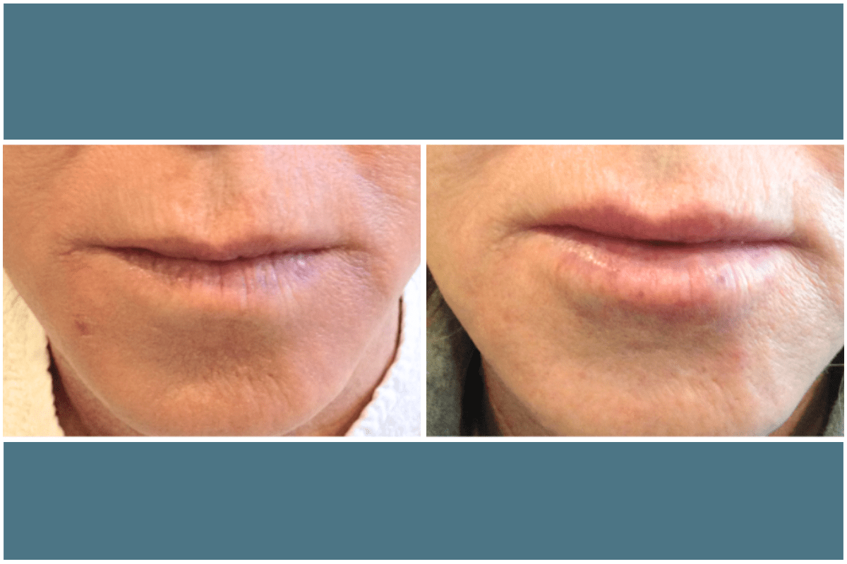 Lip-Filler-Viva-Carmel-by-the-Sea-aesthetic-dermatology-medspa-results-transformation-botox-facial.png