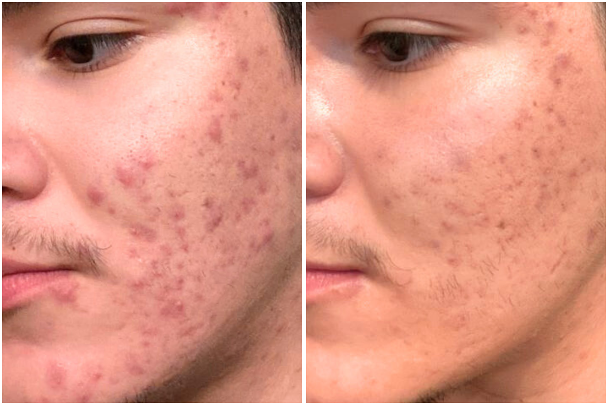 Customized Products for Acne 1.png