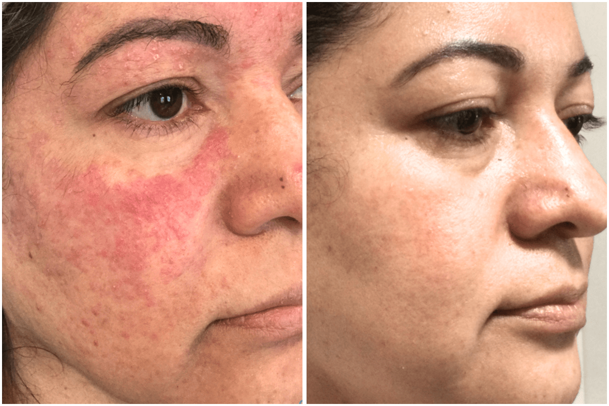 rosacea-treatment-Viva-Carmel-by-the-Sea-aesthetic-dermatology-medspa-results-transformation-products-before-after.png
