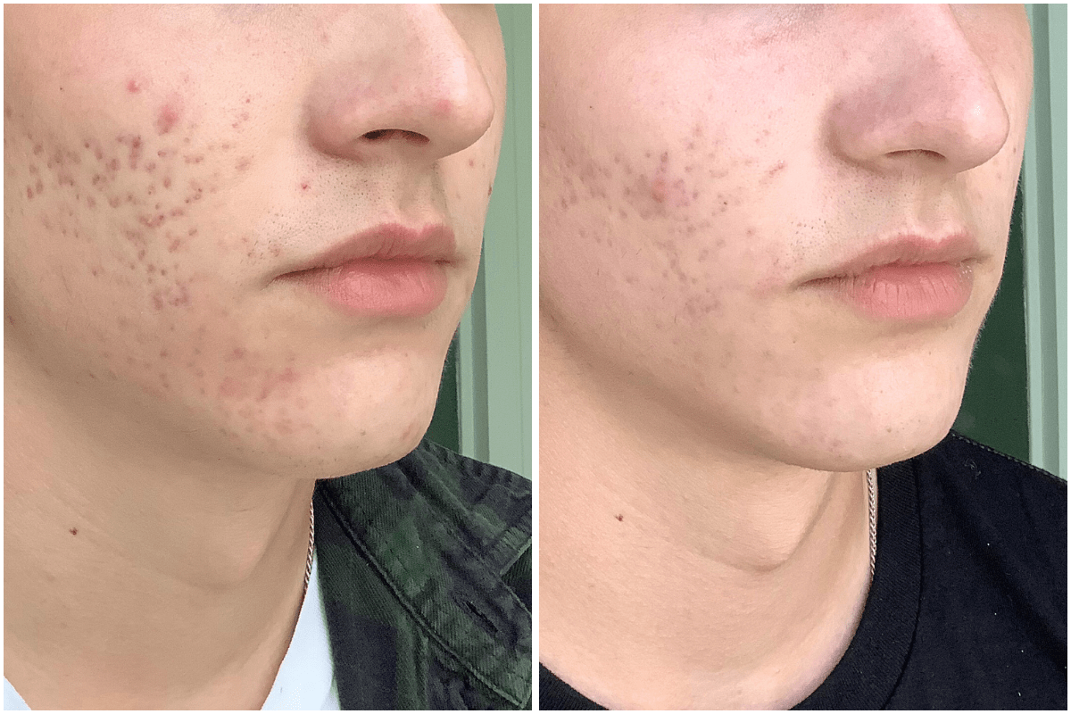 Microneedling-scar-reduction-Viva-Carmel-by-the-Sea-aesthetic-dermatology-medspa-results-transformation-botox-facial-filler.png