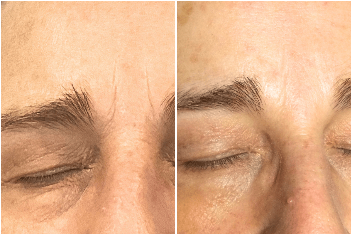 Frown-line-reduction-Viva-Carmel-by-the-Sea-aesthetic-dermatology-medspa-results-transformation-botox-facial-filler.png