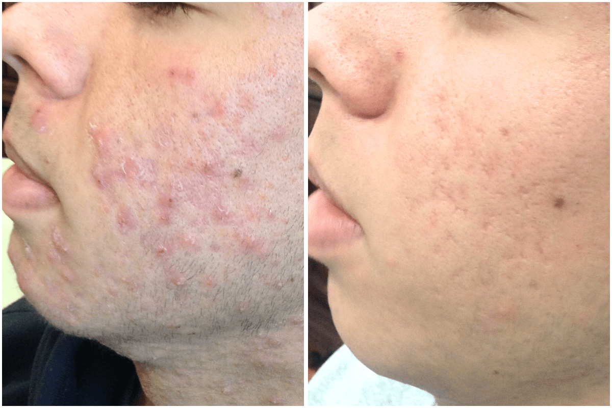 acne-treatment-Viva-Carmel-by-the-Sea-aesthetic-dermatology-medspa-results-transformation-products-before-after-2.png