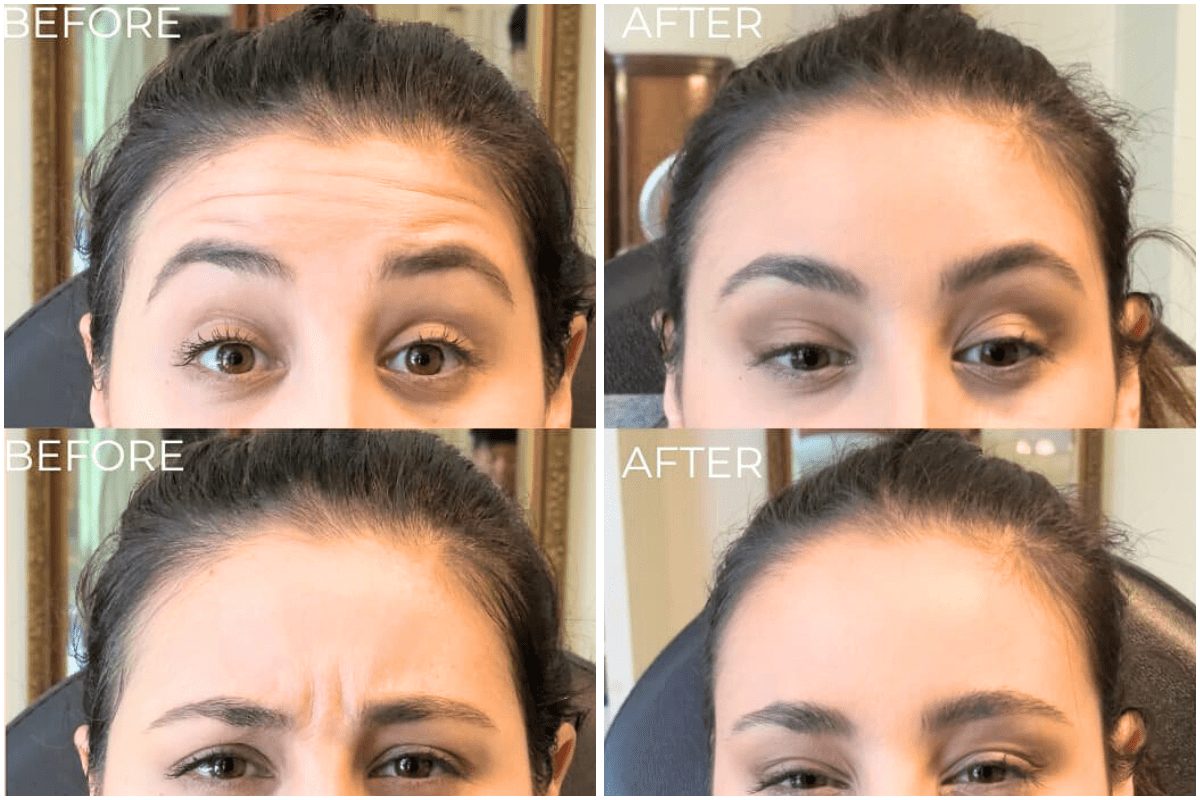 Neurotoxin-treatment-frown-lines-Viva-Carmel-by-the-Sea-aesthetic-dermatology-medspa-results-transformation-botox-facial-filler.png