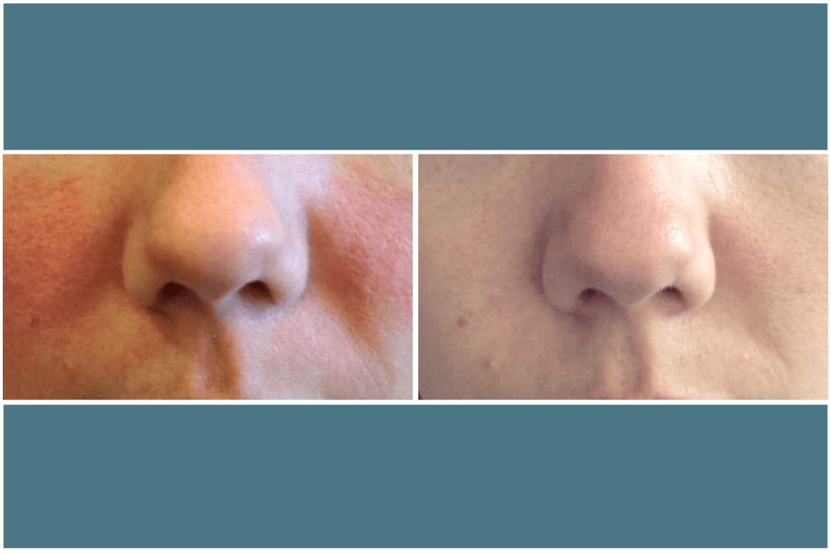 Neurotoxin-treatment-rosacea-Viva-Carmel-by-the-Sea-aesthetic-dermatology-medspa-results-transformation-botox-facial-filler.png