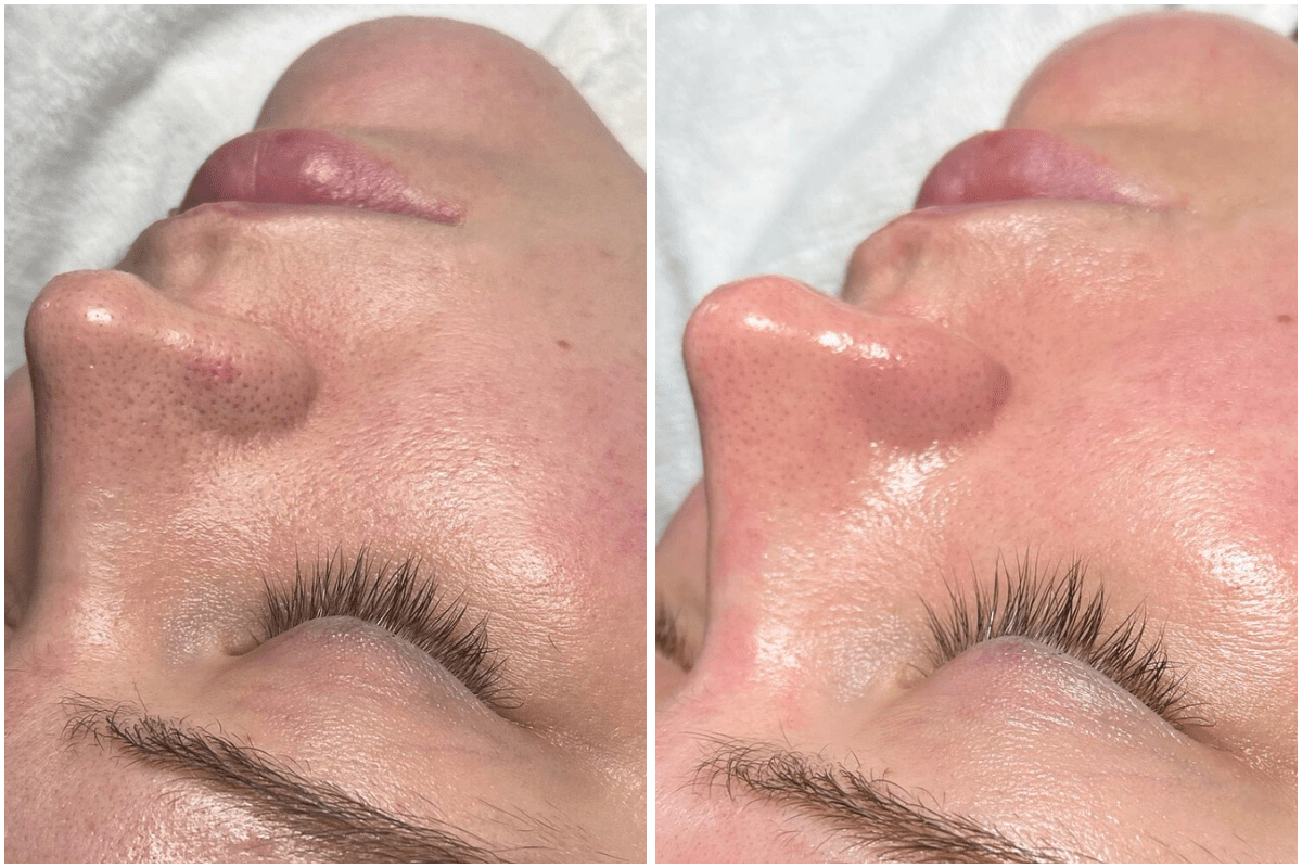 Pore Buster Treatment-Viva-Carmel-by-the-Sea-aesthetic-dermatology-medspa-results-transformation-botox-facial-filler.png