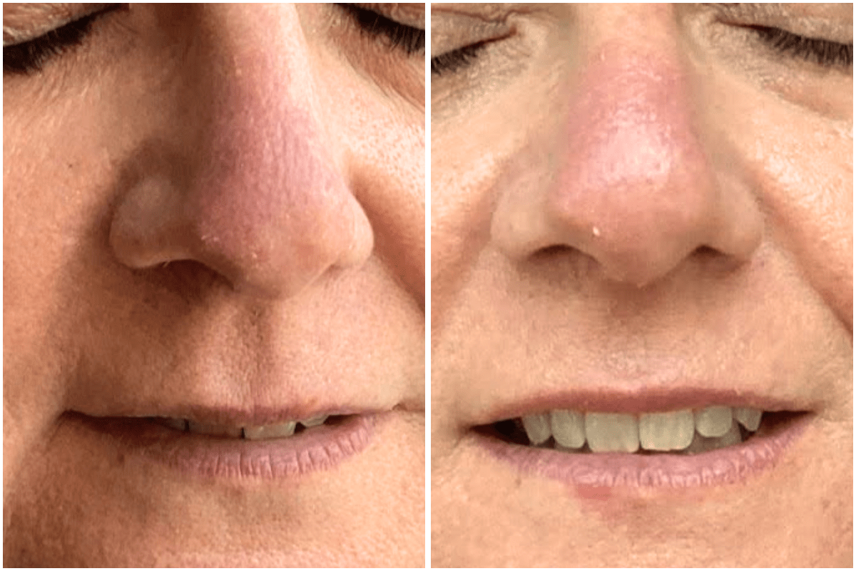 Neurotoxin-treatment-pore-shrinkage-Viva-Carmel-by-the-Sea-aesthetic-dermatology-medspa-results-transformation-botox.png