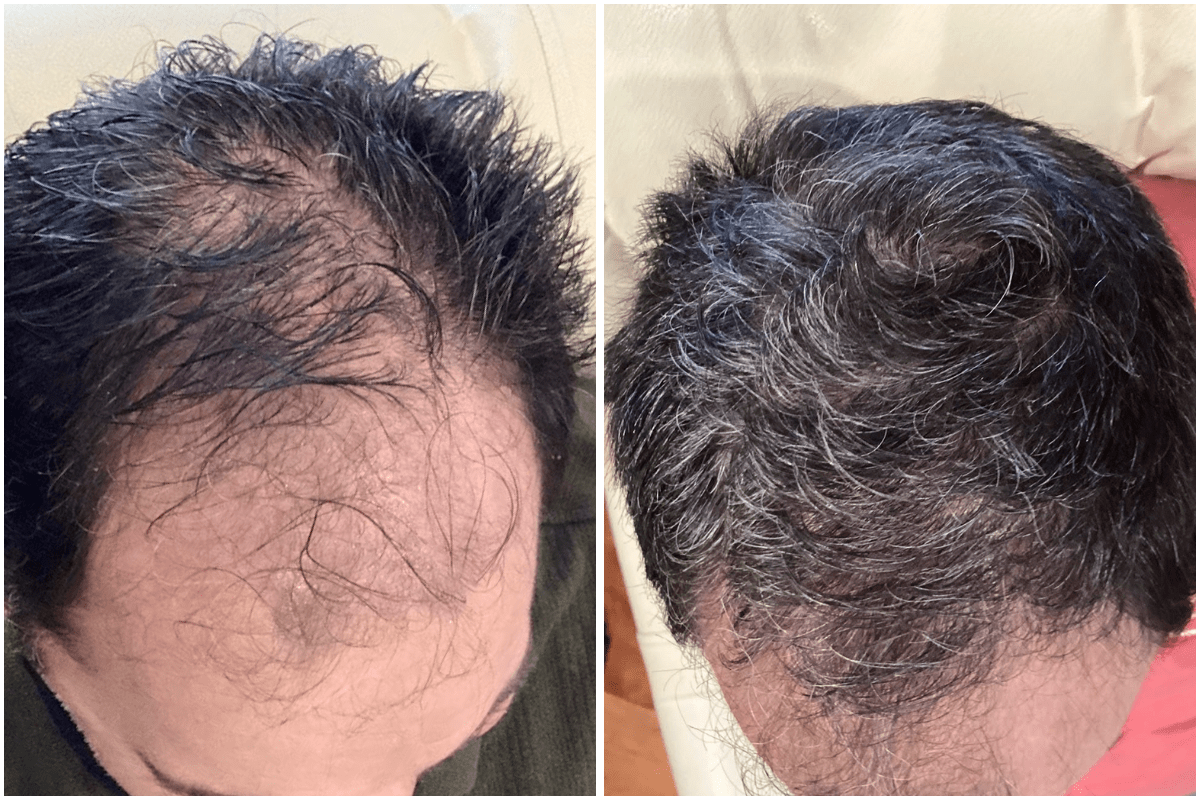 Exosomes-hair-restoration-loss-balding-Viva-Carmel-by-the-Sea-aesthetic-dermatology-medspa-results-transformation.png