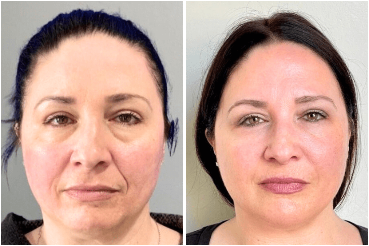 Radiesse-Viva-Carmel-by-the-Sea-aesthetic-dermatology-medspa-results-transformation-botox-facial-filler.png
