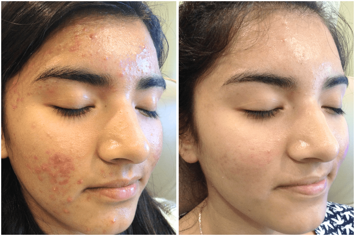 Acne-treatment-Viva-Carmel-by-the-Sea-aesthetic-dermatology-medspa-results-transformation-products-before-after.png
