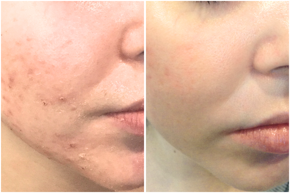 Customized products for acne treatment.png