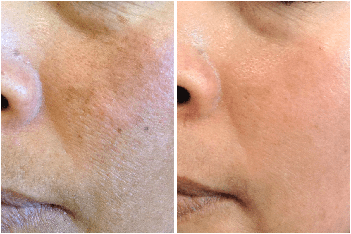 Pigmentation-melasma-Viva-Carmel-by-the-Sea-aesthetic-dermatology-medspa-results-transformation-botox-facial-filler.png